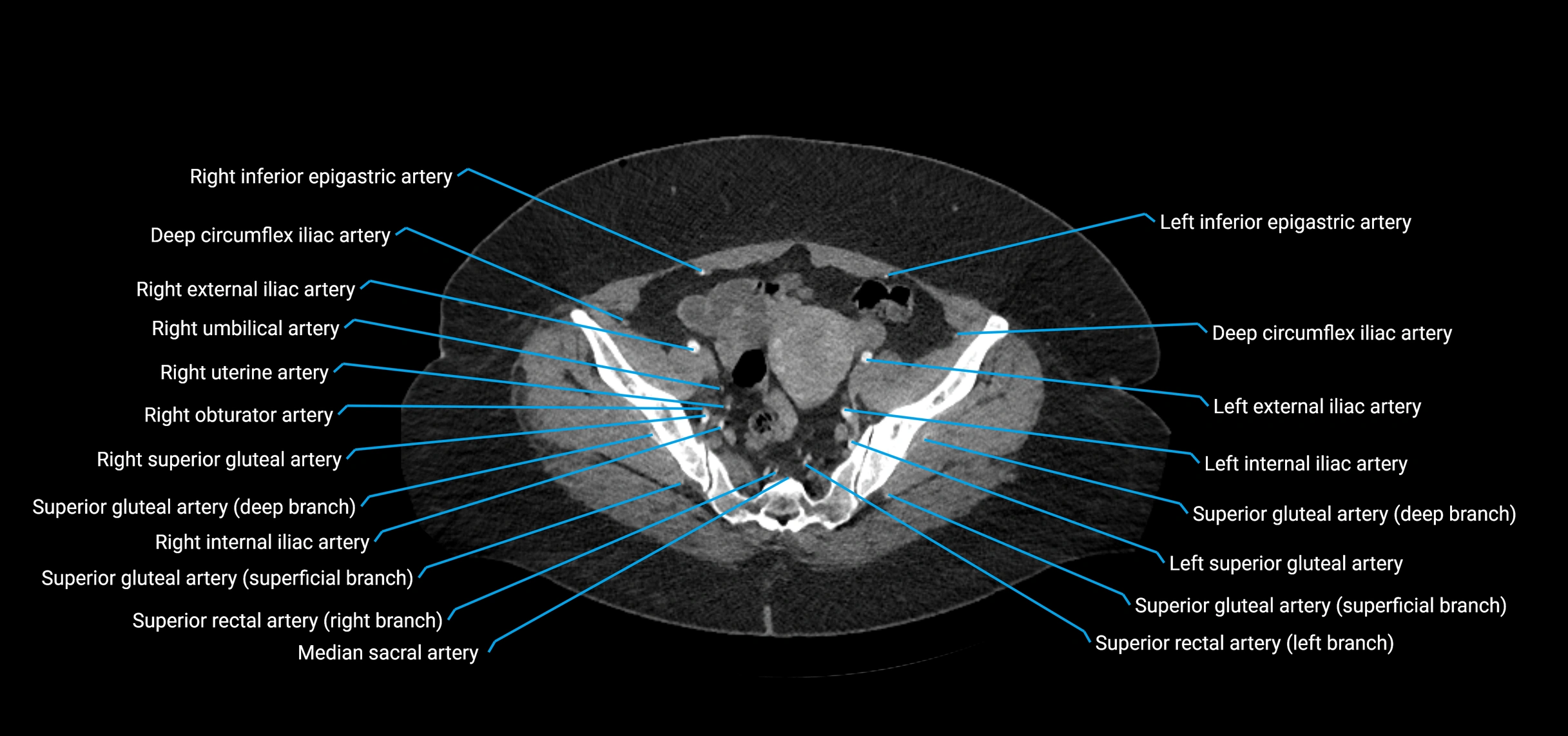 CTA abdomen axial cross sectional anatomy labelled image_207 (2).webp
